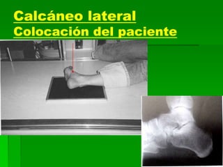 Calcáneo lateral
Colocación del paciente
 