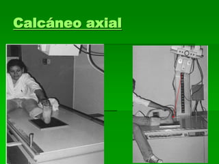Calcáneo axial
 