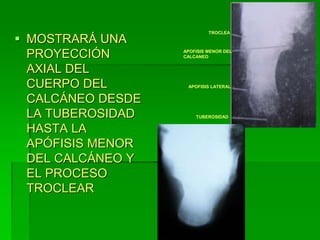  MOSTRARÁ UNA
PROYECCIÓN
AXIAL DEL
CUERPO DEL
CALCÁNEO DESDE
LA TUBEROSIDAD
HASTA LA
APÓFISIS MENOR
DEL CALCÁNEO Y
EL PROCESO
TROCLEAR
TROCLEA
APOFISIS MENOR DEL
CALCANEO
APOFISIS LATERAL
TUBEROSIDAD
 