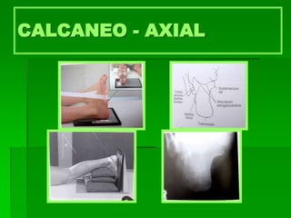 CALCANEO - AXIAL
 