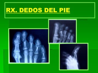 RX. DEDOS DEL PIE
 