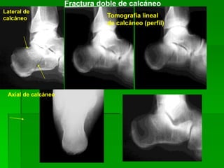 Lateral de
calcáneo
Axial de calcáneo
Tomografía lineal
de calcáneo (perfil)
Fractura doble de calcáneo
 