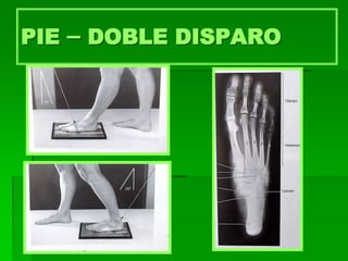 PIE – DOBLE DISPARO
 