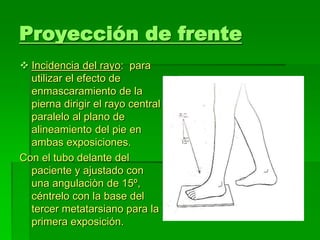 Proyección de frente
 Incidencia del rayo: para
utilizar el efecto de
enmascaramiento de la
pierna dirigir el rayo central
paralelo al plano de
alineamiento del pie en
ambas exposiciones.
Con el tubo delante del
paciente y ajustado con
una angulaciòn de 15º,
céntrelo con la base del
tercer metatarsiano para la
primera exposición.
 