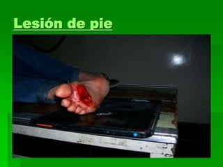 Lesión de pie
 