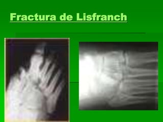 Fractura de Lisfranch
 
