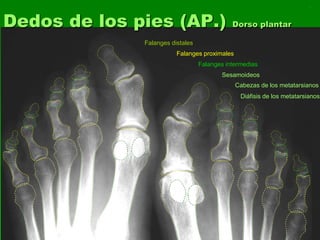 Falanges distales
Falanges proximales
Sesamoideos
Cabezas de los metatarsianos
Diáfisis de los metatarsianos
Falanges intermedias
Dedos de los pies (AP.) Dorso plantar
 