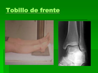 Tobillo de frente
 