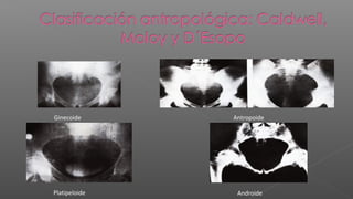 Ginecoide      Antropoide




Platipeloide    Androide
 