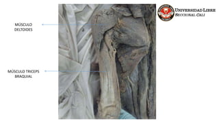 MÚSCULO
DELTOIDES
MÚSCULO TRICEPS
BRAQUIAL
 