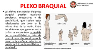 • Los daños a los nervios del plexo
braquial pueden ocasionar
problemas musculares y de
sensibilidad, que suelen estar
relacionados con dolor en la
misma área de la lesión. Entre
los síntomas que generan estos
daños se encuentran la pérdida
de la sensibilidad y falta de
control muscular en el brazo, la
mano y la muñeca, además se
puede incluir un brazo flácido o
paralizado. Medical Illustration, Human Anatomy Drawing
 