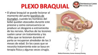 • El plexo braquial se puede lesionar al
momento del parto (parálisis de
klumpke), cuando los hombros del
bebé quedan atascados durante este
proceso y como consecuencia se
produce un desgarro o estiramiento
de los nervios. Muchas de las lesiones
suelen sanar sin tratamiento y los
niños que se lesionan durante el
parto se recuperan alrededor de los 3
meses de edad. En los casos que se
necesita tratamiento este se basa en
terapia física y algunas veces cirugía.
Medical Illustration, Human Anatomy Drawing
 