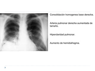 Tromboembolia pulmonar | PPT