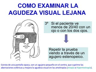 COMO EXAMINAR LA
AGUDEZA VISUAL LEJANA
3º Si el paciente ve
menos de 20/40 con un
ojo o con los dos ojos.
Repetir la prueba
viendo a través de un
agujero estenopeico.
Consta de una pantalla opaca, con un agujero pequeño en el centro, que suprime las
aberraciones esféricas y mejora la agudeza visual en las ametropías (miopía e hipermetropía).
 