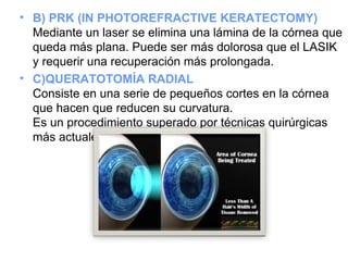 • B) PRK (IN PHOTOREFRACTIVE KERATECTOMY)
Mediante un laser se elimina una lámina de la córnea que
queda más plana. Puede ser más dolorosa que el LASIK
y requerir una recuperación más prolongada.
• C)QUERATOTOMÍA RADIAL
Consiste en una serie de pequeños cortes en la córnea
que hacen que reducen su curvatura.
Es un procedimiento superado por técnicas quirúrgicas
más actuales.
 