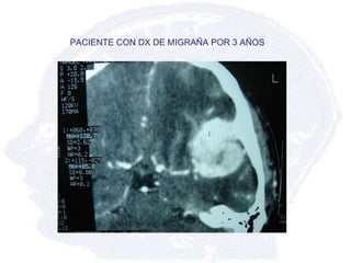 PACIENTE CON DX DE MIGRAÑA POR 3 AÑOS 
