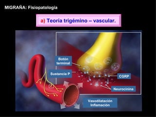 MIGRAÑA: Fisiopatología Vasodilatación Inflamación CGRP Sustancia P Neurocinina Botón terminal a)  Teoría trigémino – vascular. 
