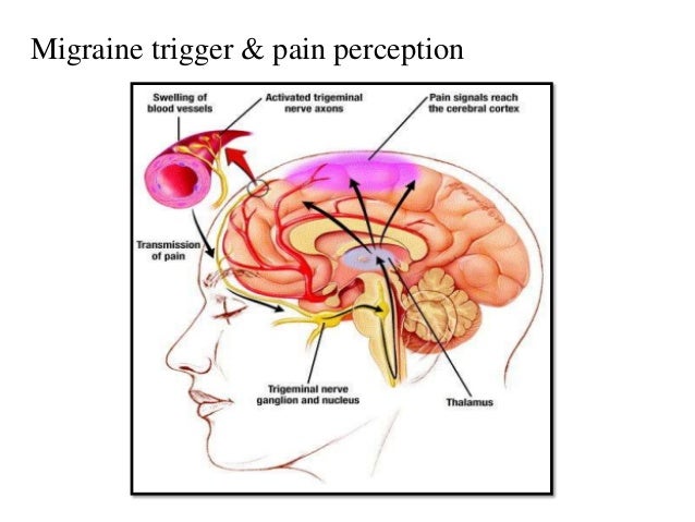 Migraine migraine pain body diagram 