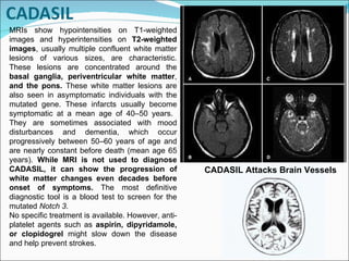 MRIs show hypointensities on T1-weighted images and hyperintensities on  T2-weighted images , usually multiple confluent white matter lesions of various sizes, are characteristic. These lesions are concentrated around the  basal ganglia, periventricular white matter ,  and the pons.  These white matter lesions are also seen in asymptomatic individuals with the mutated gene. These infarcts usually become symptomatic at a mean age of 40 – 50 years.  They are sometimes associated with mood disturbances and dementia, which occur progressively between 50 – 60 years of age and are nearly constant before death (mean age 65 years).  While MRI is not used to diagnose CADASIL, it can show the progression of white matter changes even decades before onset of symptoms.  The most definitive diagnostic tool is a blood test to screen for the mutated  Notch 3 .  No specific treatment is available. However, anti-platelet agents such as  aspirin, dipyridamole, or clopidogrel  might slow down the disease and help prevent strokes. CADASIL Attacks Brain Vessels 