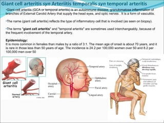 Giant cell arteritis (GCA or temporal arteritis) is an autoimmune disease, granulomatose inflammation of branches of External Carotid Artery that supply the head eyes, and optic nerves . It is a form of vasculitis. The name (giant cell arteritis) reflects the type of inflammatory cell that is involved (as seen on biopsy). The terms " giant cell arteritis " and "temporal arteritis" are sometimes used interchangeably, because of the frequent involvement of the temporal artery.  Epidemiology: It is more common in females than males by a ratio of 3:1. The mean age of onset is about 70 years, and it is rare in those less than 50 years of age. The incidence is 24.2 per 100,000 women over 50 and 8.2 per 100,000 men over 50 