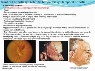 Clinical Presentation: Unilateral headache, pulsating pain more sever at night Fever  Tenderness and sensitivity on the scalp  Jaw claudication (pain in jaw when chewing)  inflammation of internal maxillary artery Tongue claudication (pain in tongue when chewing) and necrosis Reduced visual acuity (blurred vision)  Acute visual loss (sudden blindness)  Diplopia (double vision)  Acute tinnitus (ringing in the ears)  Approximately 50% of GCA patients also have polymyalgia rhematica (PMR), which is characterized by muscle pain and stiffness. The inflammation may affect blood supply to the eye and blurred vision or sudden blindness may occur. In 76% of cases involving the eye, the ophthalmic artery is involved causing  anterior ischemic optic neuropathy . Loss of vision in both eyes may occur very abruptly and this disease is therefore a medical emergency. Amaurosis fugax may precede the blindness Anterior ischemic optic neuropathy resulting from giant cell arteritis. The optic nerve is swollen, and there are surrounding hemorrhages. 