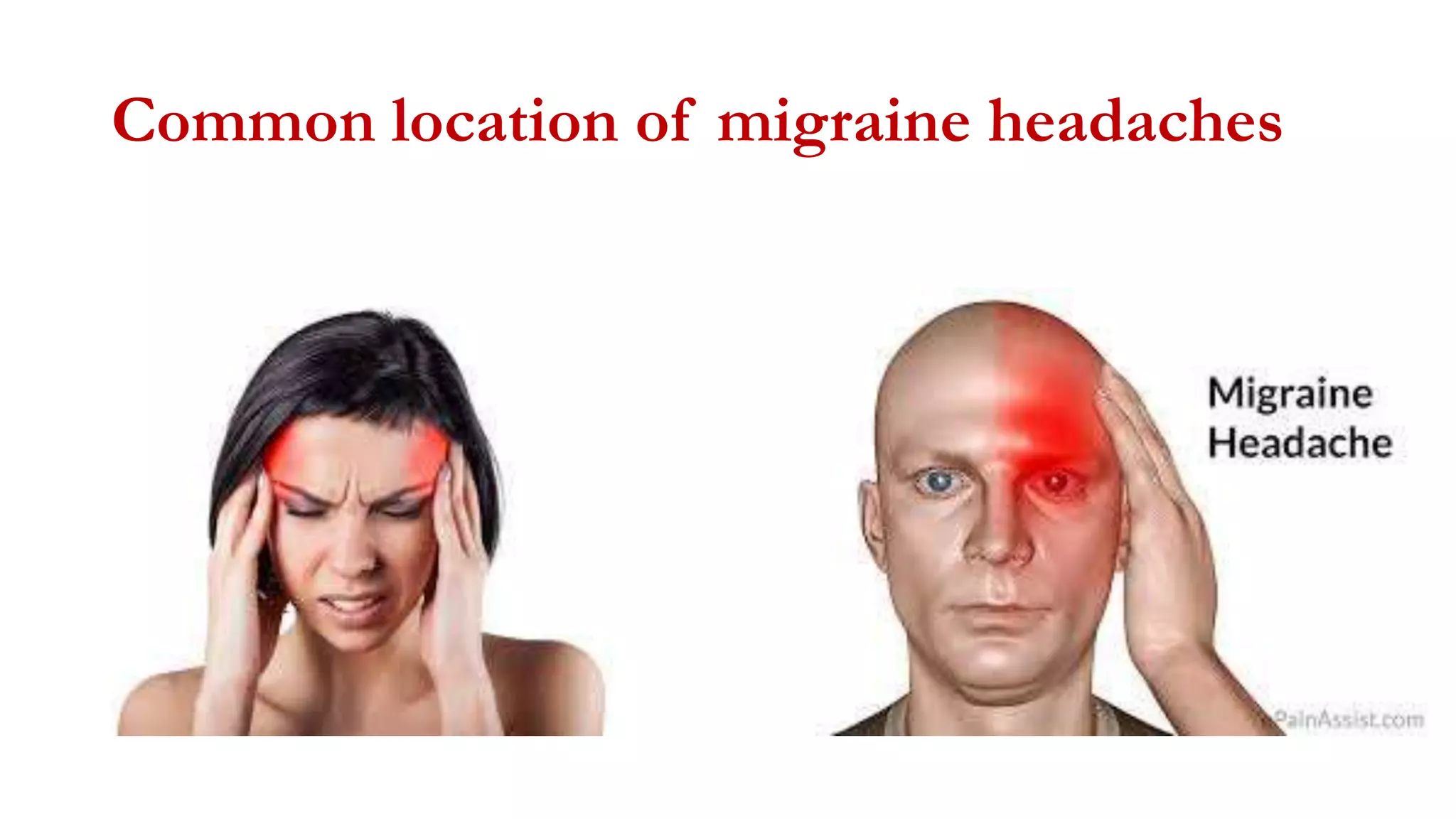 Migraine | PPTX