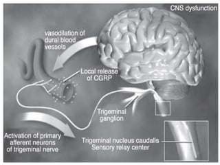 Migraine and types | PPTX