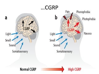 Pharmacological management of migraine | PPT