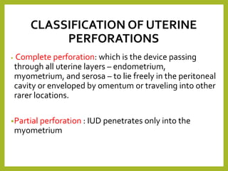 Iud Rupture Migration of iud (dr.rafi rozan) | PPTX