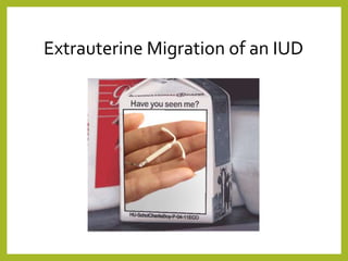 Migration Risk Iud Migration of iud (dr.rafi rozan) | PPTX