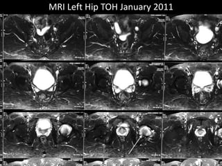 MRI Left Hip TOH January 2011
 
