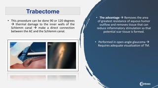• This procedure can be done 90 or 120 degrees
 thermal damage to the inner walls of the
Schlemm canal  make a direct connection
between the AC and the Schlemm canal.
• The advantage  Removes the area
of ​​greatest resistance of aquous humor
outflow and removes tissue that can
reduce inflammatory stimulation so that
potential scar tissue is formed.
• Performed in open-angle glaucoma 
Requires adequate visualization of TM.
Trabectome
 