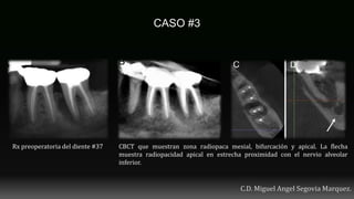 Rx preoperatoria del diente #37 CBCT que muestran zona radiopaca mesial, bifurcación y apical. La flecha
muestra radiopacidad apical en estrecha proximidad con el nervio alveolar
inferior.
 