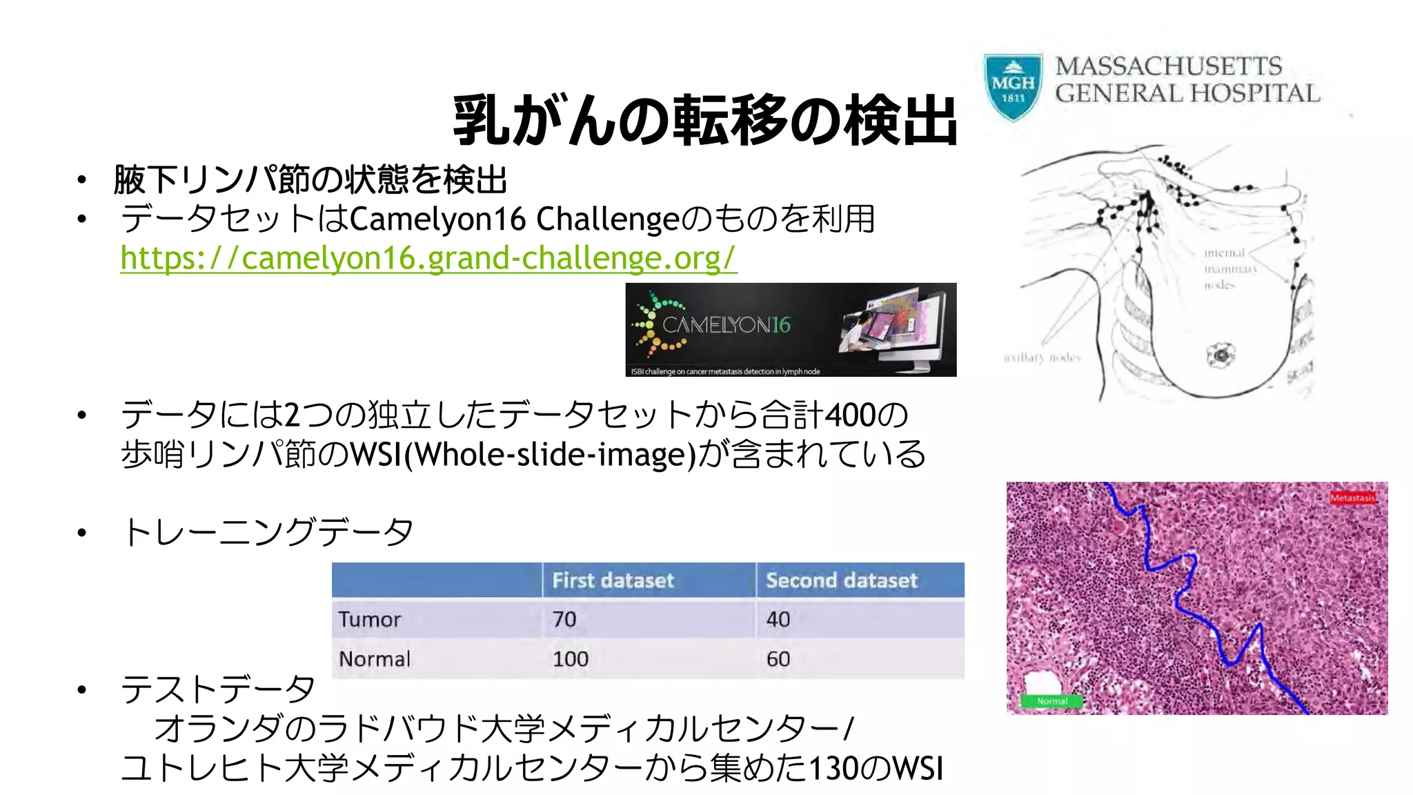 乳がんの転移の検出
• 腋下リンパ節の状態を検出
• データセットはCamelyon16 Challengeのものを利用
https://camelyon16.grand-challenge.org/
• データには2つの独立したデータセットから合計400の
歩哨リンパ節のWSI(Whole-slide-image)が含まれている
• トレーニングデータ
• テストデータ
オランダのラドバウド大学メディカルセンター/
ユトレヒト大学メディカルセンターから集めた130のWSI
 