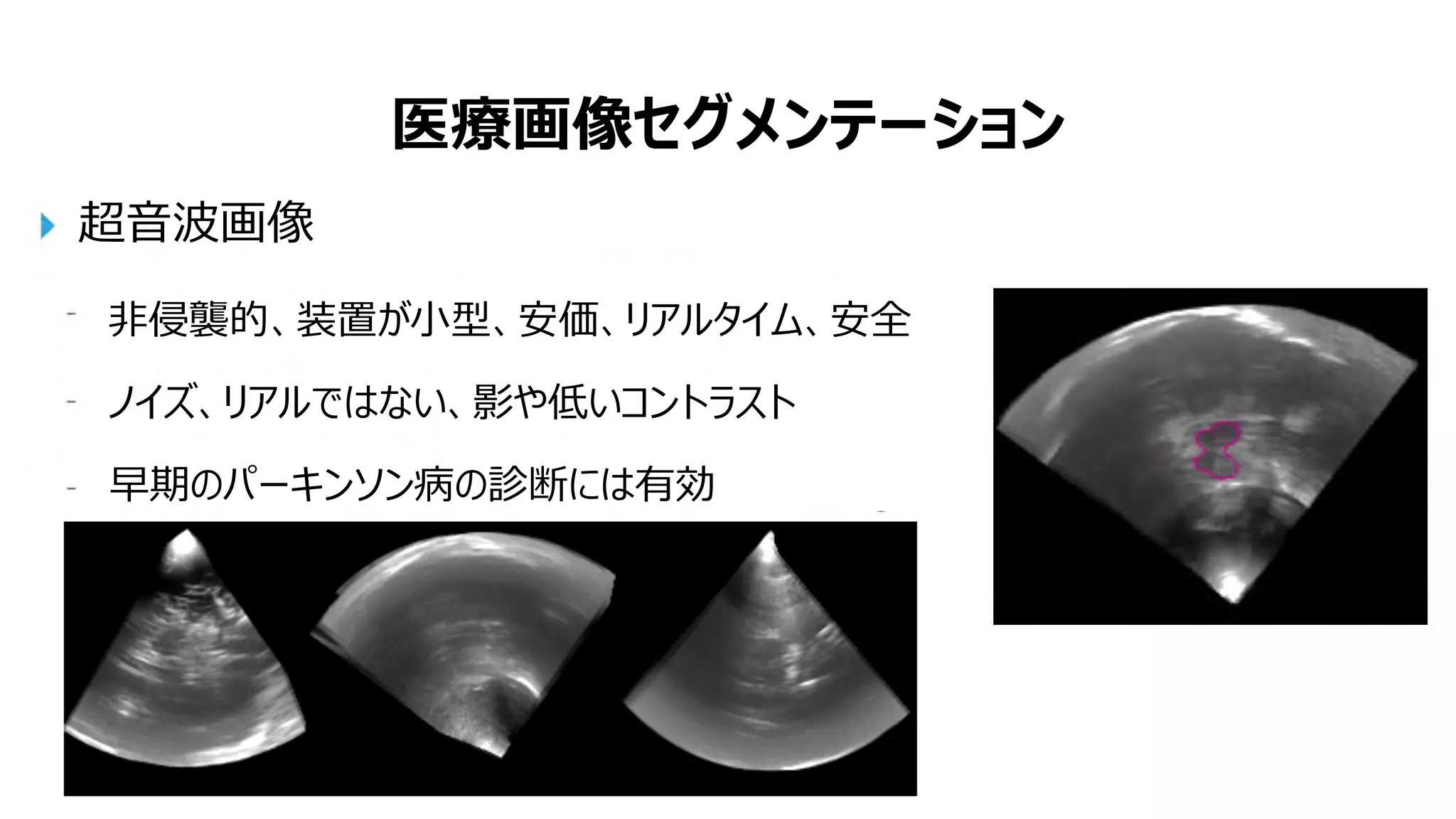医療画像セグメンテーション
超音波画像
非侵襲的、装置が小型、安価、リアルタイム、安全
ノイズ、リアルではない、影や低いコントラスト
早期のパーキンソン病の診断には有効
 