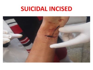 SUICIDAL INCISED
 