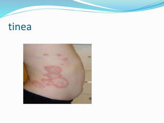 tinea
 