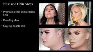 • Protruding chin and receding
nose
• Receding chin
• Sagging double chin
Nose and Chin Areas
 
