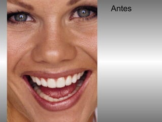 Antes 
