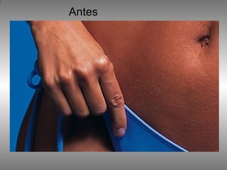 Antes 