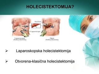 <ul><li>Laparoskopska holecistektomija </li></ul><ul><li>Otvorena-klasična holecistektomija </li></ul>HOLECISTEKTOMIJA? 