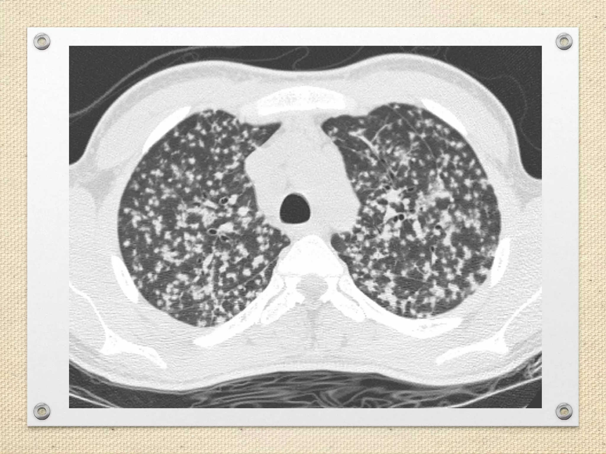 Understanding the tuberculosis granuloma: the matrix revolutions: Trends in  Molecular Medicine, image size:2048x1536