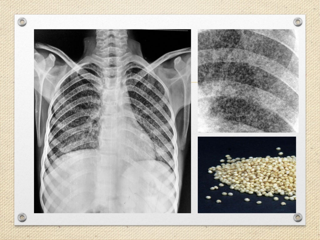 Miliary Tuberculosis (dr. mahesh)