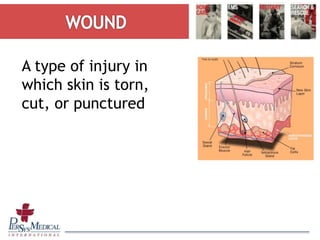 A type of injury in
which skin is torn,
cut, or punctured
 