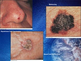 Basal Cell Carcinoma Melanoma Squamous Cell Carcinoma 