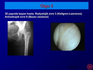 SÖZEN
Olgu 5Olgu 5
36 yaşında bayan hasta. Radyolojik evre 3 (Kellgren-Lawrence)36 yaşında bayan hasta. Radyolojik evre 3 (Kellgren-Lawrence)
Artroskopik evre 6 (Bauer-Jackson)Artroskopik evre 6 (Bauer-Jackson)
 