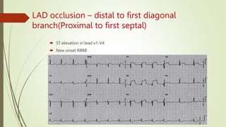 LAD occlusion – distal to first diagonal
branch(Proximal to first septal)
 ST elevation in lead v1-V4
 New onset RBBB
 