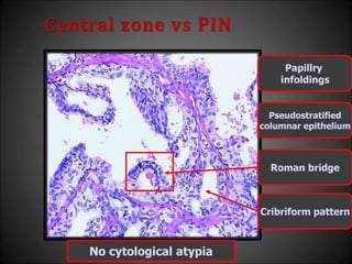 Central zone vs PIN
Cribriform pattern
Roman bridge
Papillry
infoldings
Pseudostratified
columnar epithelium
No cytological atypia
 