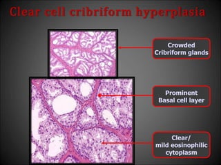 Clear cell cribriform hyperplasia
Crowded
Cribriform glands
Prominent
Basal cell layer
Clear/
mild eosinophilic
cytoplasm
 