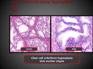 Clear cell cribriform hyperplasia
vs
PIN
CCCH PIN
Clear cell cribriform hyperplasia
lack nuclear atypia
 